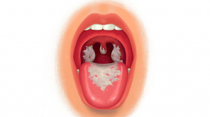 Diphtheria Spreads in Coimbatore: Symptoms and Prevention of Diphtheria. Photo Healthand.