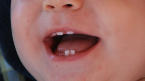 Bizarre SIGNS in Baby Teeth connects to ADHD, Autism