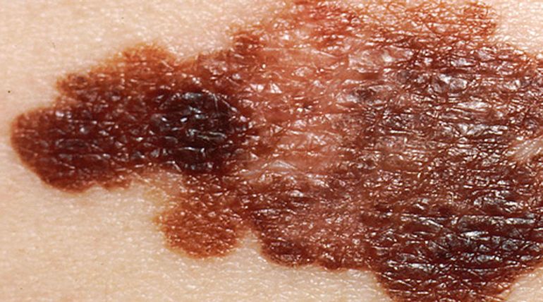 Skin Cancer: Vitamin D can Scrutinize Melanoma via VDR