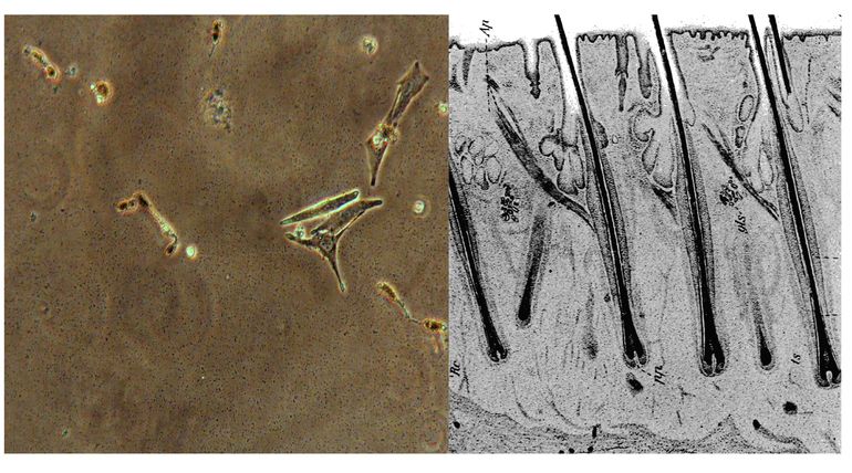 Skin Cancer probably have Its Origin In Hair Follicles