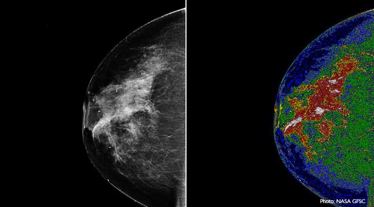 Is 3D breast cancer detection better than the 2D