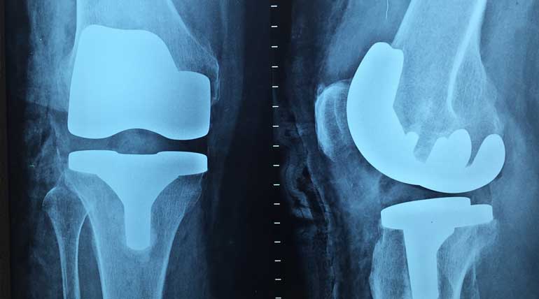 Knee surgery details that help to have a happy life