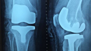 Knee surgery details that help to have a happy life